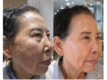 ルミライ(Lumirai)/自宅でできるたるみとシワケア