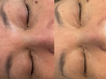 グレイティア(gratia)/韓国ウル艶ララピール施術1回