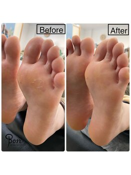 ネイルアトリエ ボン(nail atelier bon)/足裏角質ケア