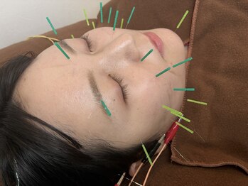 わせだのもり整骨院の写真/【全身鍼灸・美容鍼で細胞から活性化！】身体の不調の改善に対してさまざまな効果があります☆
