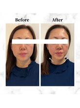 ザビューティー 麻布十番本店(The Beauty)/12Dリフト全顔打ち放題[リフト]