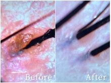 ベリルスパトリートメント(BERYL SPA TREATMENT)/毛穴汚れがスッキリ!/ヘッドスパ