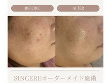 シンシア(SINCERE)/オーダーメイド肌改善プログラム