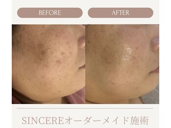 シンシア(SINCERE)/オーダーメイド肌改善プログラム