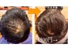 【男性必見◎】育毛促進スパ10分+頭浸浴+ ヒト幹細胞導入+照射20分¥13200