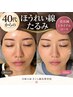 40代からの【ほうれい線・たるみ】美容鍼トライアルコース