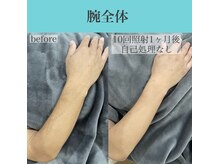 アクト クロ(ACT curro)/【腕全体】脱毛施術例