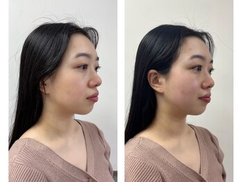 ヘッドミントVIP 岐阜店/岐阜小顔矯正施術前後