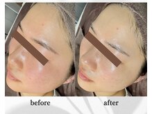 アン ビューティー(ann beauty)/施術1回【症例写真】20代女性