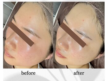 アン ビューティー(ann beauty)/施術1回【症例写真】20代女性