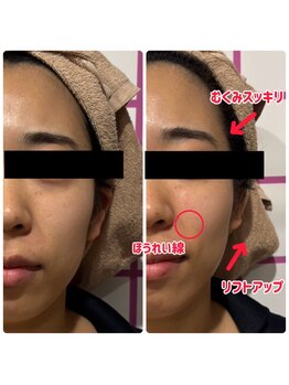 世田谷ビューティークリニーク 池尻大橋/小顔リフトトリートメントの効果