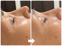 サロン ド ジョワ(salon de joie)/目じりのシワ改善！