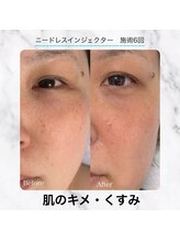 エクラ 六本木(eclat)/最新水光高圧ジェットで肌質改善