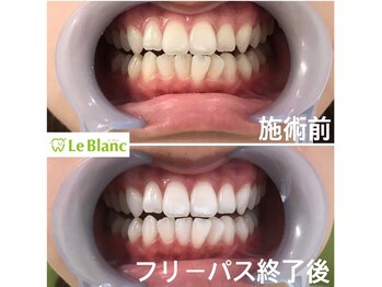 ルブラン 奈良店(Le Blanc)/映える白い歯！