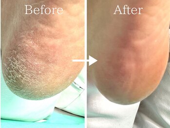 巻き爪補正店 大曽根店/かかとケア(施術前と施術後)
