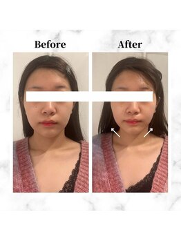 ザビューティー 麻布十番本店(The Beauty)/12Dリフト全顔打ち放題[リフト]