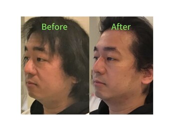 ラプリ 福岡博多店(Raplit)/メンズも歓迎☆美鼻&小顔