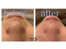 リジュベ(Rejuve)/毛穴洗浄/毛穴エステ/船橋毛穴