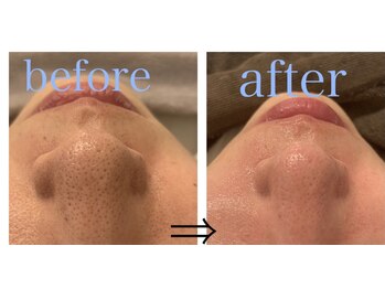 リジュベ(Rejuve)/毛穴洗浄/毛穴エステ/船橋毛穴