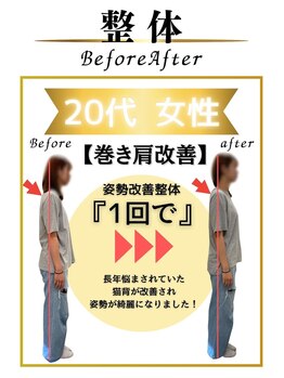 みなもと整骨院/20代　巻き肩