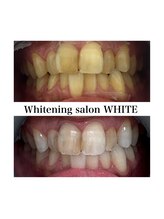 ホワイトニングサロン ホワイト 津山店(WHITE)/ビフォーアフター