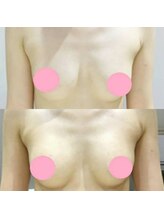 ルミエール(Lumiere)/【倉敷市】バストアップ施術事例