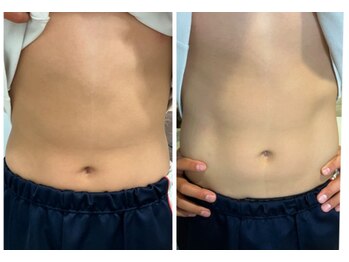 クー(9 Kuu)/痩身◇フォースカッター&EMS