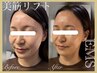 衰えた筋肉を正しい位置に戻し若見え小顔|美筋EMSリフト(美容液導入付き)