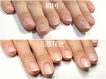 5週間後の変化 フィルイン