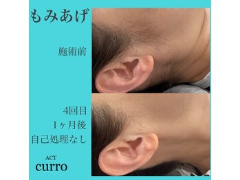 アクト クロ(ACT curro)/【うなじ襟足】脱毛施術例