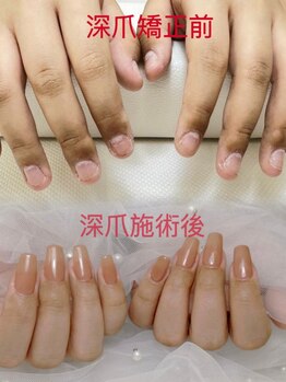 モナサロン(Mona salon)の写真/深爪/貝爪/むしり癖等のお悩みの方★縦長で綺麗な美爪に♪爪の形や長さにコンプレックスがある方もお任せ♪