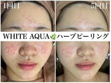 ホワイトアクア 姫路店(WHITE AQUA)/ハーブピーリング/姫路/美肌