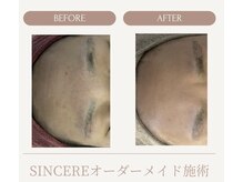 シンシア(SINCERE)/オーダーメイド肌改善プログラム