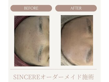 シンシア(SINCERE)/オーダーメイド肌改善プログラム