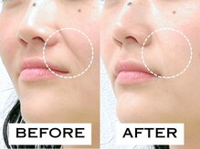 ビハリスト 秋葉原電気街口店/ ほうれい線が改善！