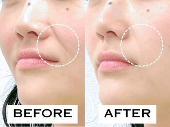 ビハリスト 秋葉原電気街口店/ ほうれい線が改善！