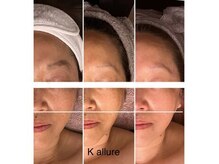 シミシワ改善ケア！