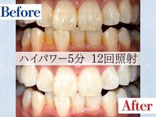 LBSホワイトニング 吉祥寺店/ホワイトニングビフォーアフター