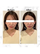 ザビューティー 麻布十番本店(The Beauty)/12Dリフト全顔打ち放題[リフト]