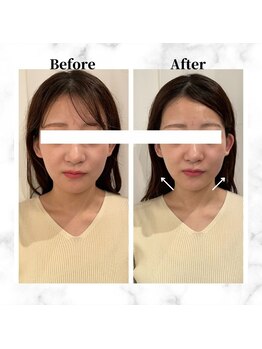 ザビューティー 麻布十番本店(The Beauty)/12Dリフト全顔打ち放題[リフト]