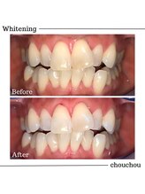 シュシュ(chouchou)/歯のセルフホワイトニング比較