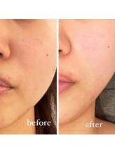 ジーニー(Genie)/ハーブピーリングで透明感