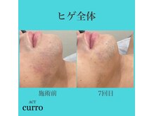 アクト クロ(ACT curro)/【ヒゲ全体】脱毛施術例