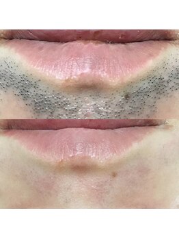 メンズサロンエヌエー(MEN'S SALON NA)/【青髭改善】ヒゲ脱毛