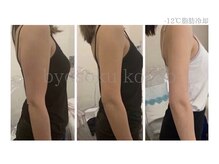 メディカルエステ 大宮店/＊日本初-12℃脂肪冷却症例＊