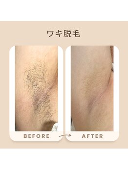 サラ(Sara)/ワキ脱毛★