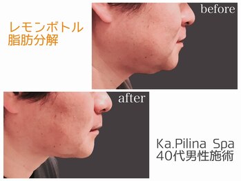 カピリナスパ(Ka.Pilina Spa)/レモンボトル before⇒after