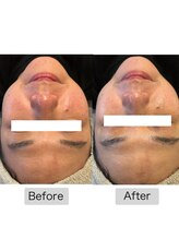 フイユ(feuille)/ILLUSTRIOUS 美白ピーリング