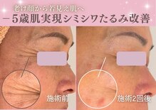 ビューティーワンド ココ(Beauty Wand COCO)