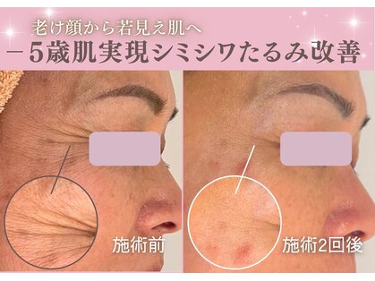 ビューティーワンド ココ(Beauty Wand COCO)の写真